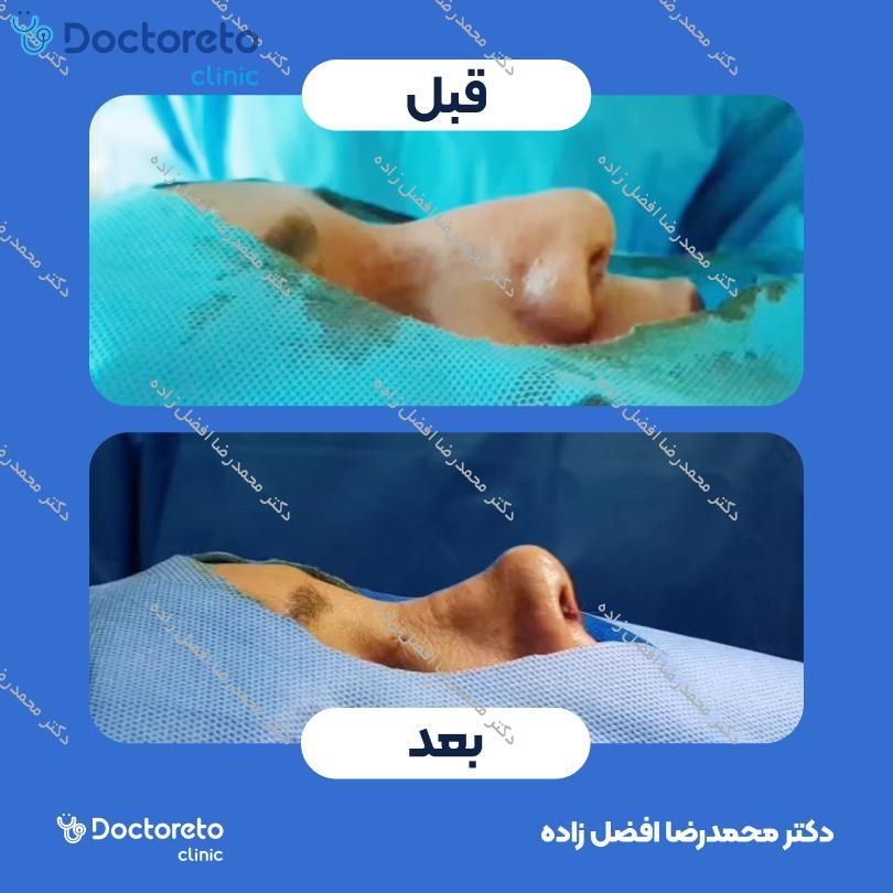 عمل جراحی مجدد زیبایی بینی (رینوپلاستی) دکتر محمدرضا افضل زاده در مشهد 4