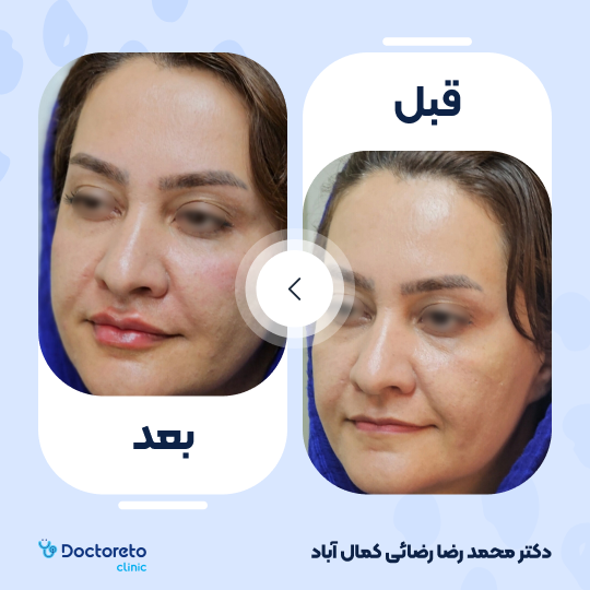 تزریق ژل لب با برند رووفیل (1cc) دکتر محمدرضا رضائی کمال آباد در کرمان 2