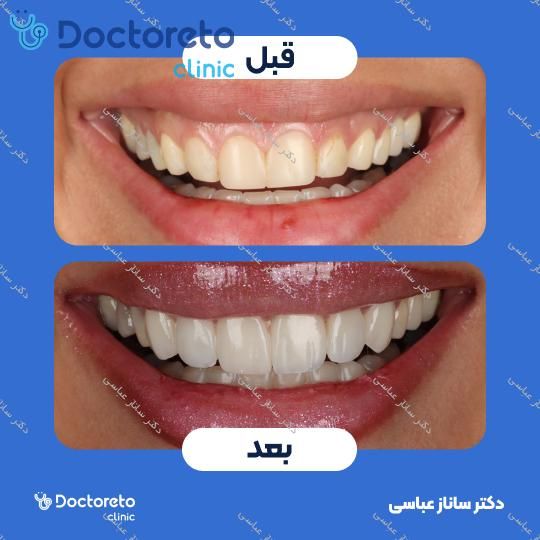 آفیس بلیچینگ (سفید کردن دندان) هر فک با مواد اولترادنت آمریکایی