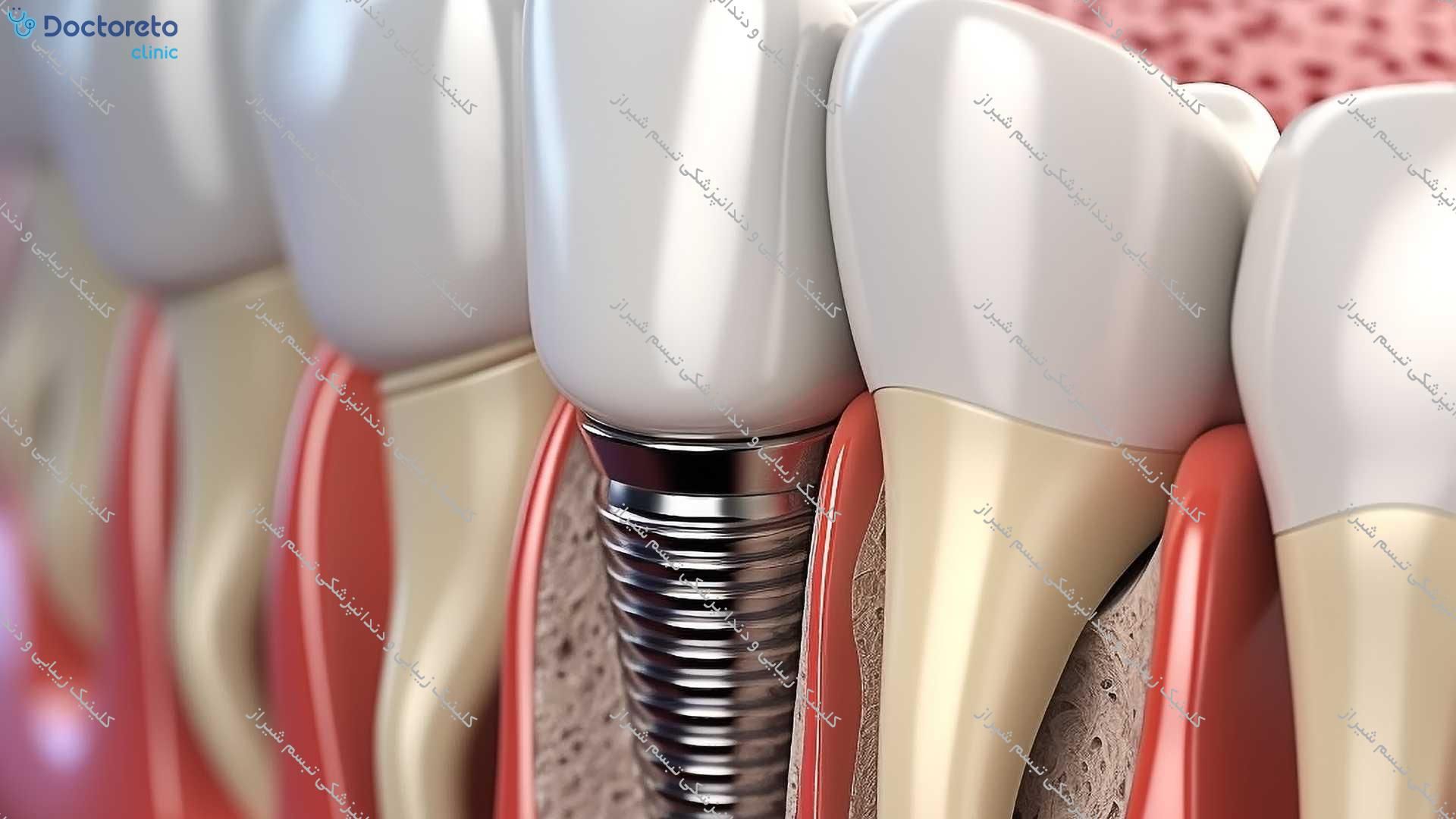 ایمپلنت دیجیتال دنتیس کره ای بدون روکش (هر واحد) کلینیک زیبایی و دندانپزشکی تبسم شیراز در شیراز 2