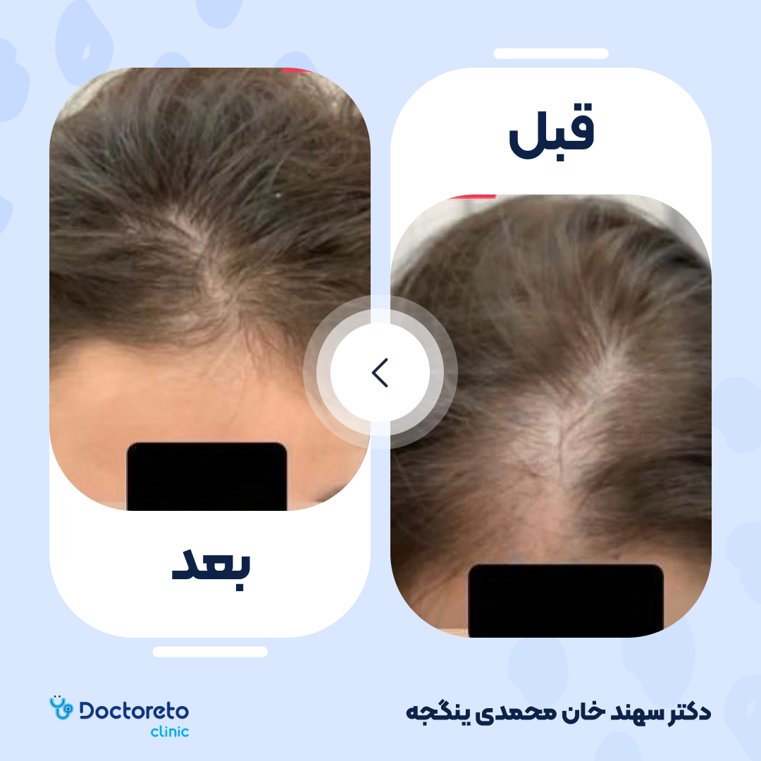 مزوتراپی مو با برند مزوتک (هر جلسه)