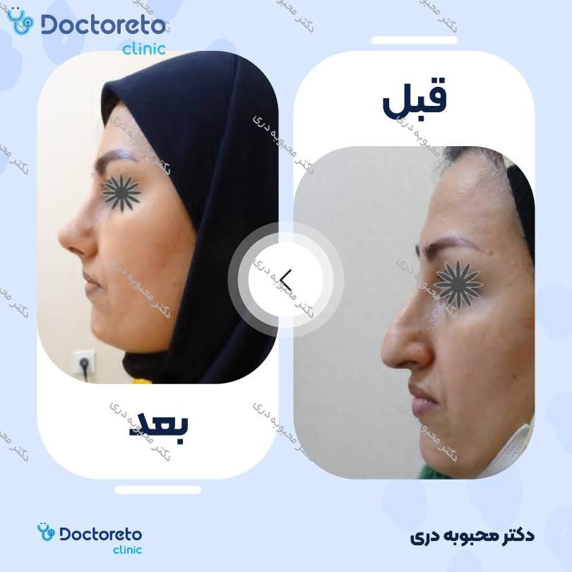 عمل زیبایی بینی (رینوپلاستی) دکتر محبوبه دری در مشهد 10