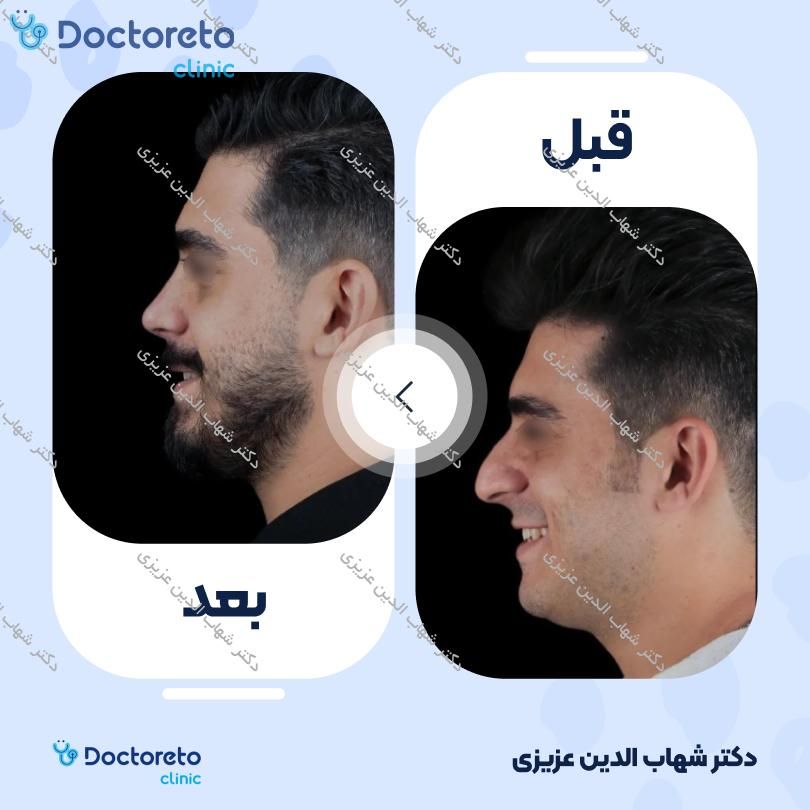 عمل زیبایی بینی (رینوپلاستی) دکتر شهاب الدین عزیزی در تهران 2