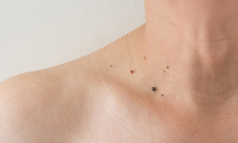 برداشتن ضایعات پوستی (skin tags) با دستگاه RF (ده عدد)