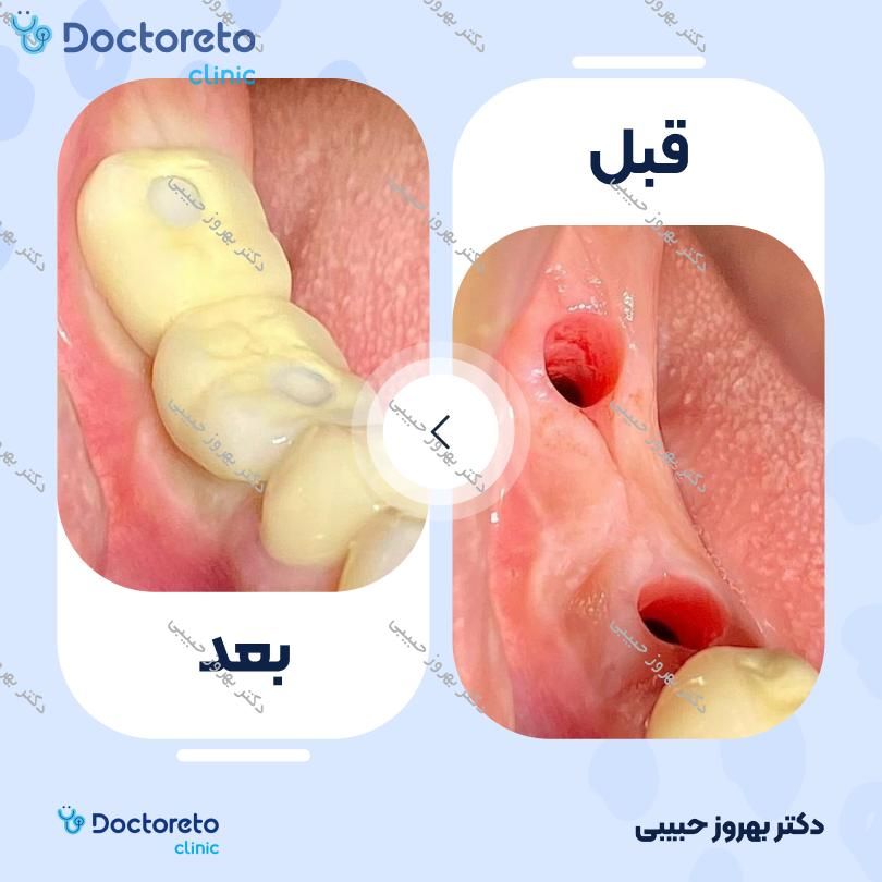 ایمپلنت آلمانی بایوتری (bio3) با روکش تمام سرامیک ( هر واحد ) دکتر بهروز حبیبی در تهران 11