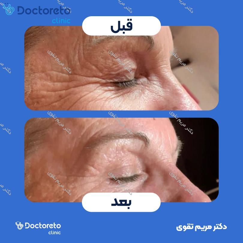 تزریق بوتاکس صورت (خطوط پنجه کلاغی دور چشم) با برند دیستون