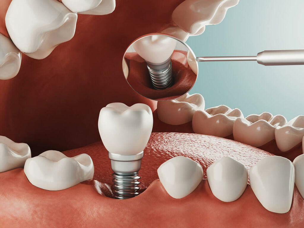 ایمپلنت bio3 المان بدون روکش (هر واحد)