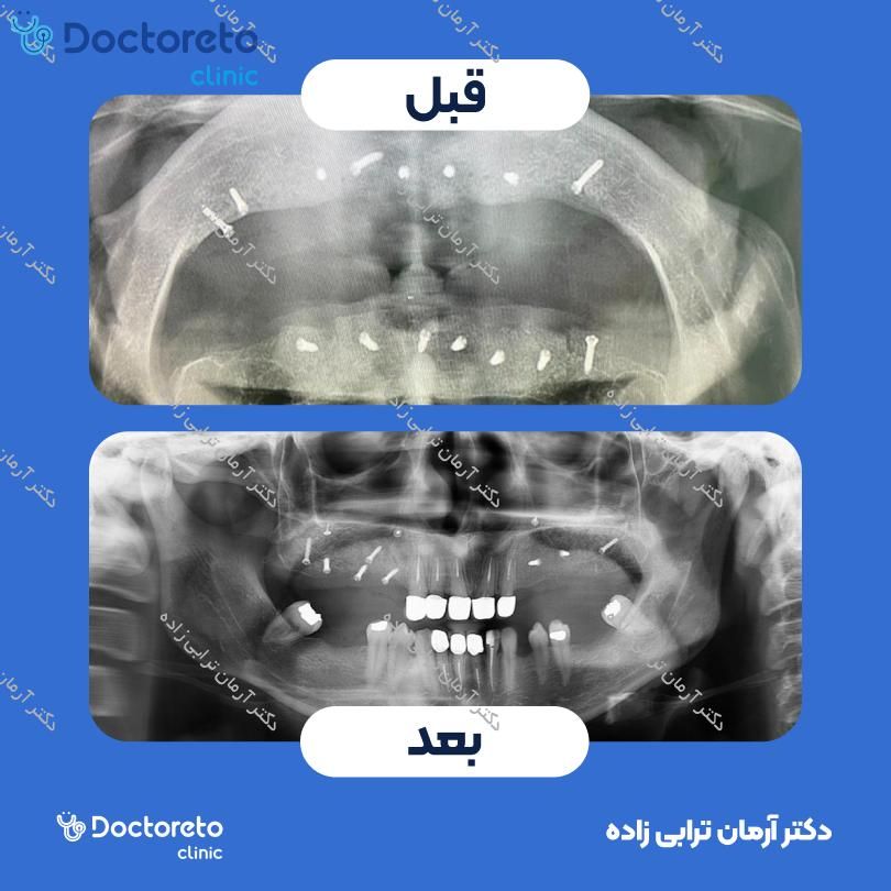 جراحی سینوس لیفت باز ممبران آلمانی دکتر آرمان ترابی زاده در تهران 19