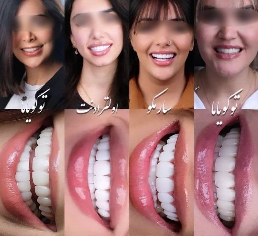 ونیر کامپوزیت دندان با برند توکویاما ژاپنی (هر واحد) دکتر بیتا جهانیان در مشهد 6