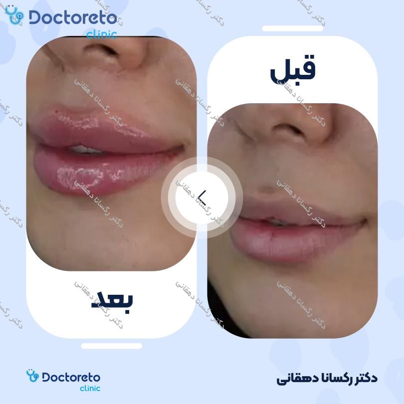 تزریق ژل لب با برند درمال استایل (1cc)