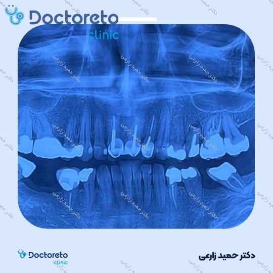 ایمپلنت Bio3 آلمانی با روکش (هر واحد)