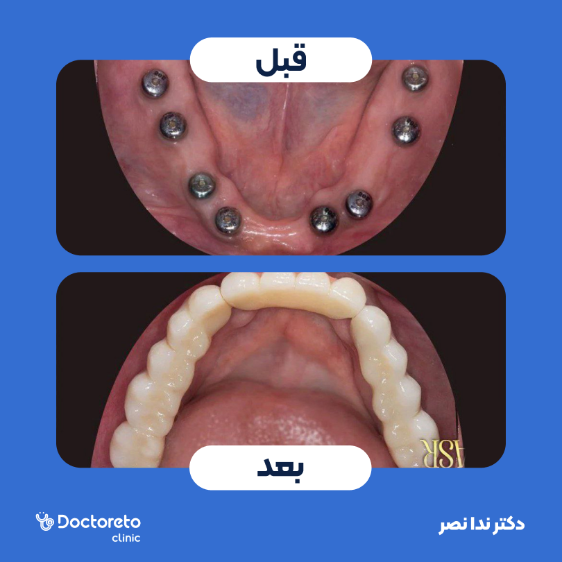 ایمپلنت بایوتم کره ای با روکش (هر واحد)