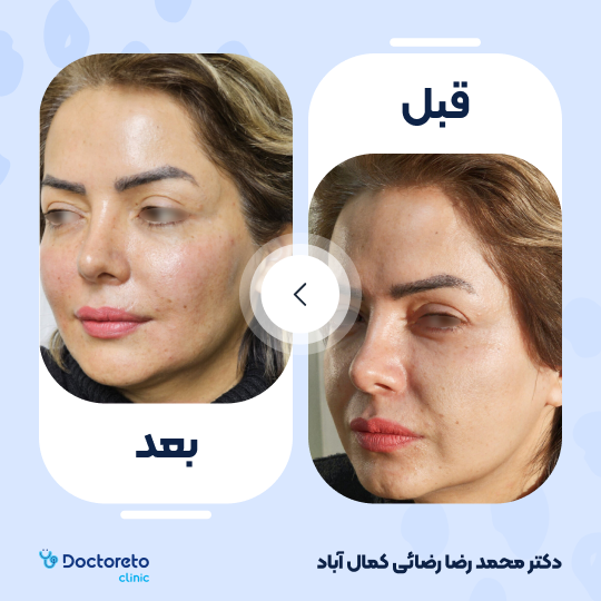 تزریق ژل گونه با برند اینوسنس (1CC)