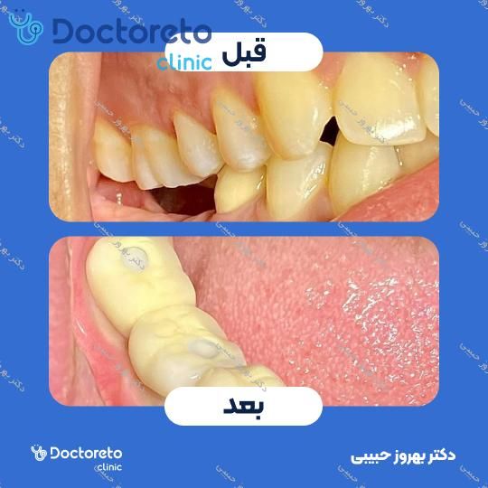 ایمپلنت اس پی آی سوئیسی (SPI) با روکش تمام سرامیکی (هر واحد) دکتر بهروز حبیبی در تهران 11