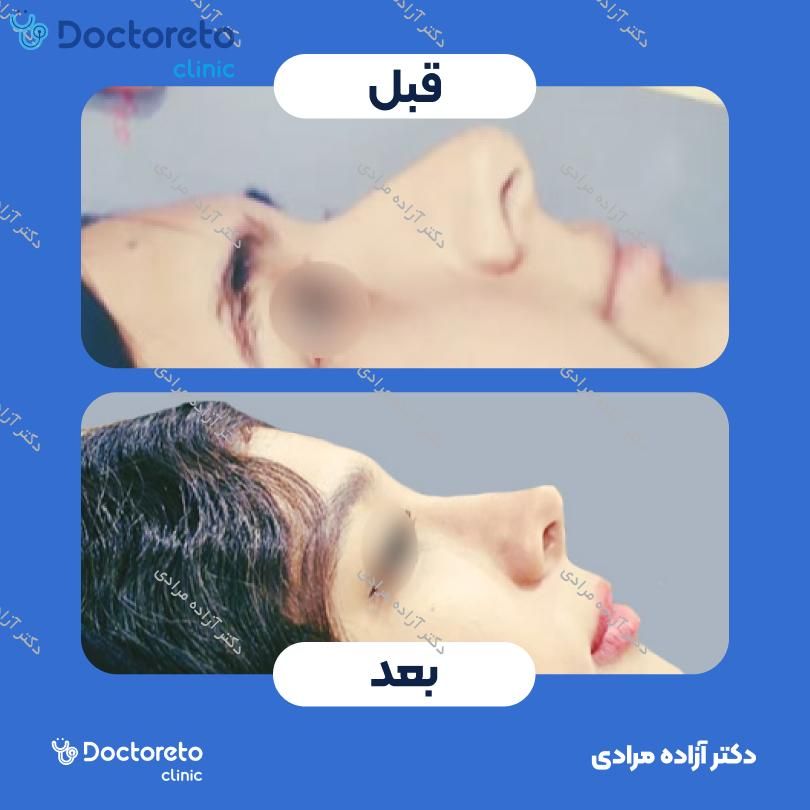 عمل جراحی بینی (رینوپلاستی) دکتر آزاده مرادی در شیراز 9