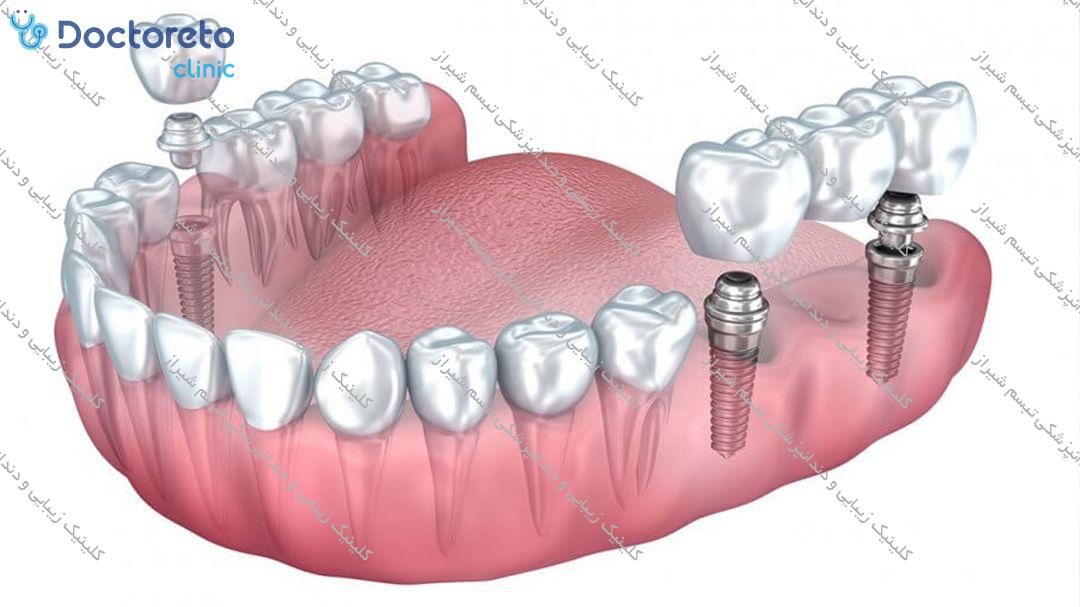 ایمپلنت دیجیتال دنتیس کره ای با روکش (هر واحد) کلینیک زیبایی و دندانپزشکی تبسم شیراز در شیراز 2