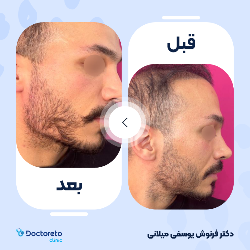 تزریق ژل زاویه فک با برند رووفیل (1CC)