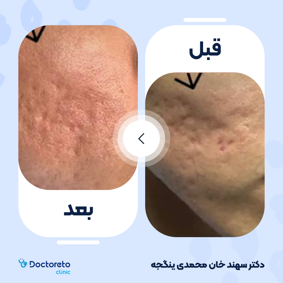 رفع جای جوش، آکنه و اسکار به روش سابسیژن (یک جلسه)