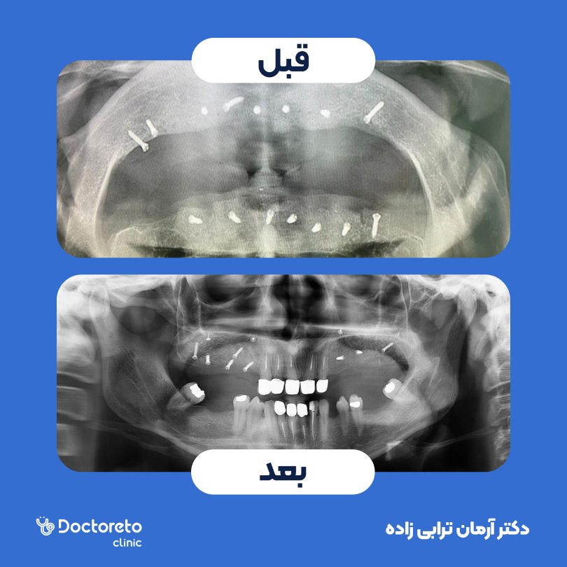 ایمپلنت اشترومن ساده تیتانیومی سوئیسی با روکش (هر واحد) دکتر آرمان ترابی زاده در تهران 16