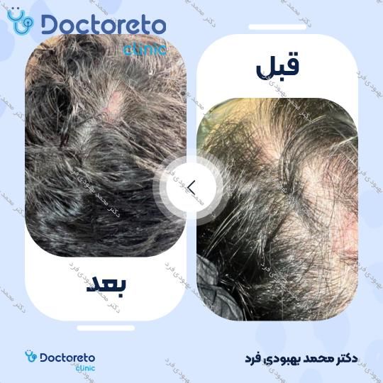 تزریق هیر فیلر مو جهت قطع ریزش مو با برند DR CYJ (هر جلسه)