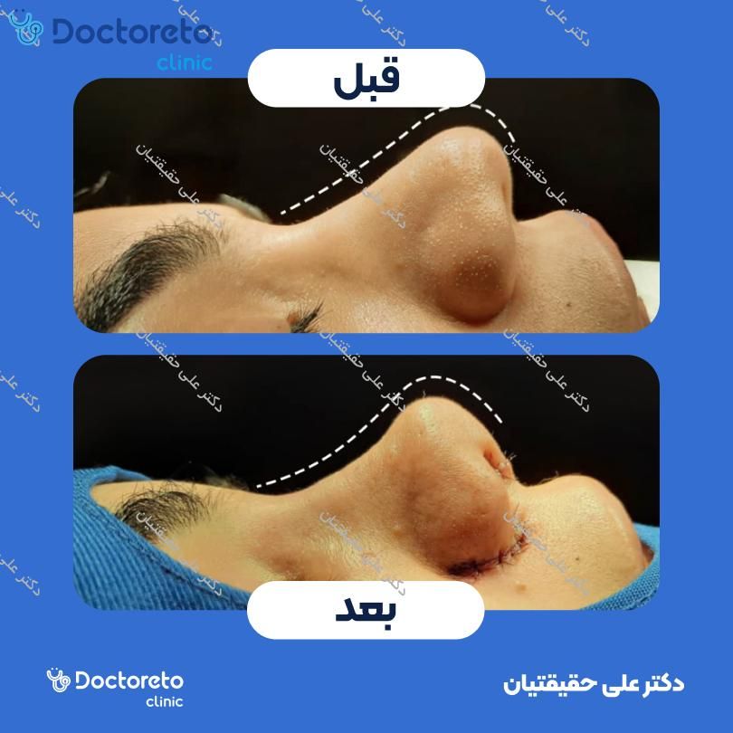 عمل جراحی مجدد زیبایی بینی (رینوپلاستی) دکتر علی حقیقتیان در شیراز 8