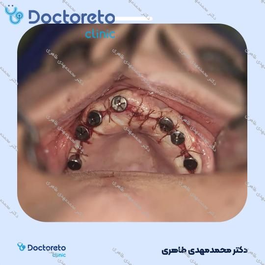 ایمپلنت نئودنت (neodent) سوئیسی همراه با روکش (هر واحد) دکتر محمدمهدی طاهری در شیراز 3