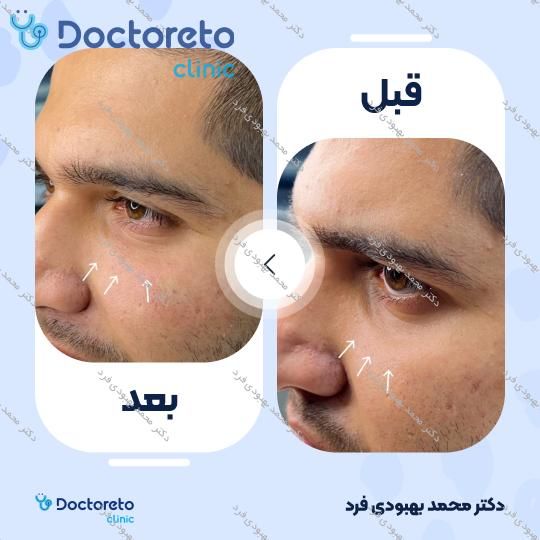 تزریق ژل زیر چشم با برند رووفیل فاین (1CC) دکتر محمد بهبودی فرد در مشهد 2