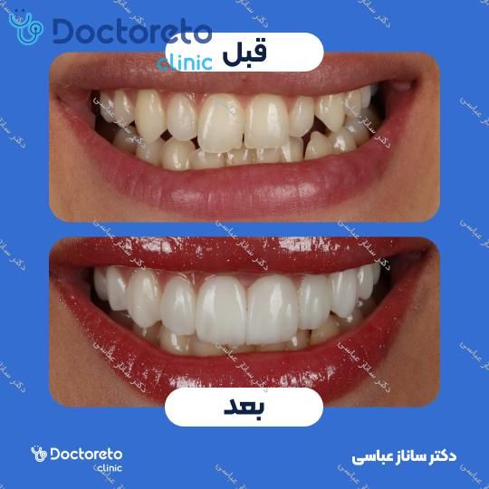 آفیس بلیچینگ (سفید کردن دندان) هر فک با مواد اولترادنت آمریکایی دکتر ساناز عباسی در تهران 5