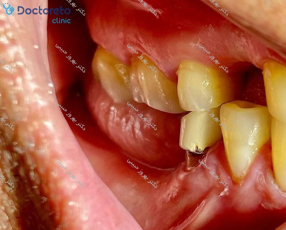 ایمپلنت آلمانی بایوتری (bio3) با روکش تمام سرامیک ( هر واحد ) دکتر بهروز حبیبی در تهران 8