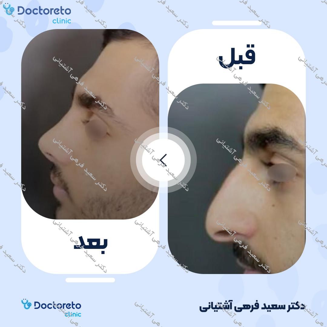 عمل زیبایی بینی (رینوپلاستی) دکتر سعید فرهی آشتیانی در بابل 5