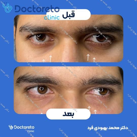 تزریق ژل زیر چشم با برند رووفیل فاین (1CC)