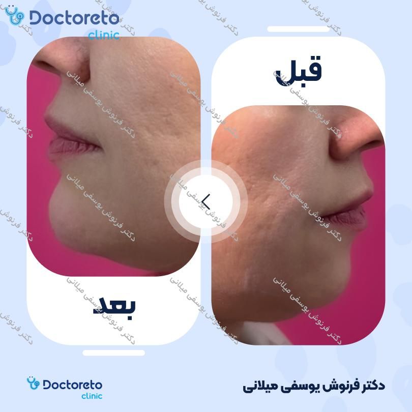 تزریق ژل لب با برند نورامیس (1CC)