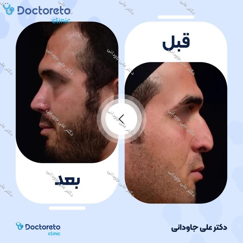 عمل زیبایی بینی (رینوپلاستی) دکتر علی جاودانی در تهران 10