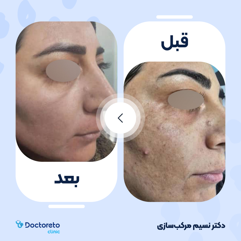 جوانسازی صورت با لیزر rf فرکشنال (یک جلسه) دکتر نسیم مرکب سازی در تهران 5