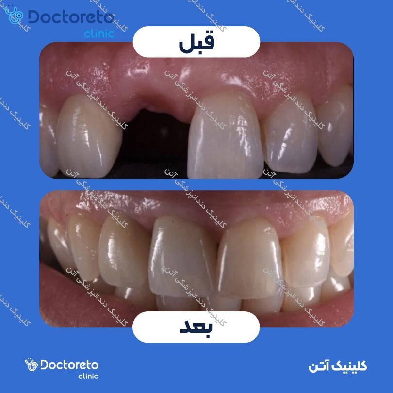 ایمپلنت کره ای همراه با روکش کلینیک دندانپزشکی آتن در تهران 3