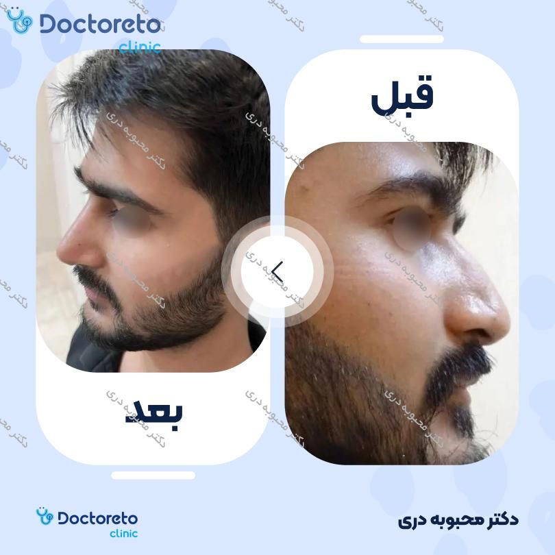 عمل زیبایی بینی (رینوپلاستی)