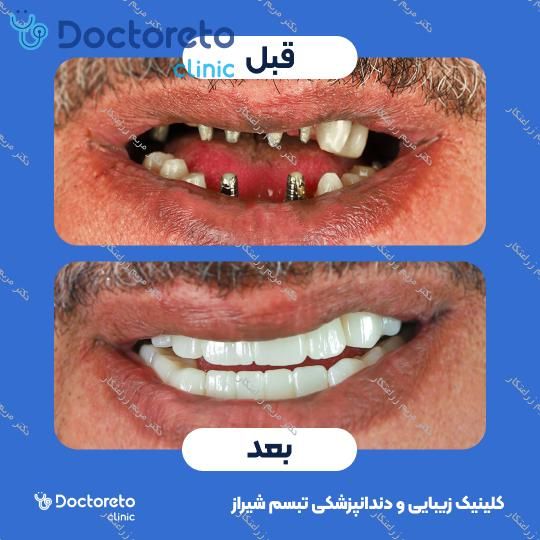 روکش ایمپلنت دیجیتال دنتیس کره ای (هر واحد) دکتر مریم زراعتکار در شیراز 7