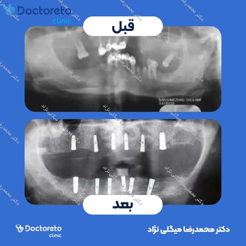 ایمپلنت دیو کره ای با روکش (هر واحد) دکتر محمدرضا میگلی نژاد در شیراز 7