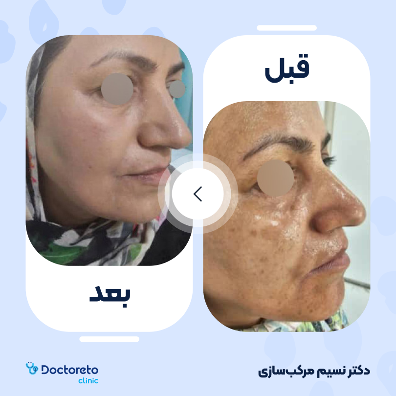 جوانسازی صورت با لیزر rf فرکشنال (یک جلسه) دکتر نسیم مرکب سازی در تهران 6