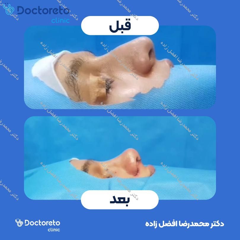 عمل جراحی مجدد زیبایی بینی (رینوپلاستی) دکتر محمدرضا افضل زاده در مشهد 2