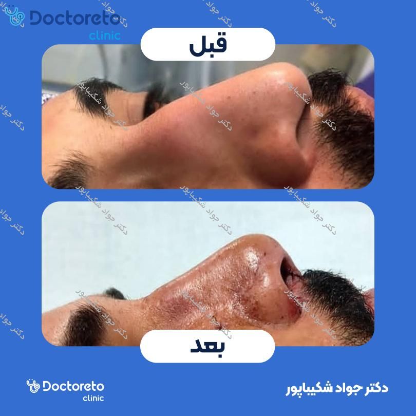 عمل زیبایی بینی (رینوپلاستی) دکتر جواد شکیباپور در شیراز 4