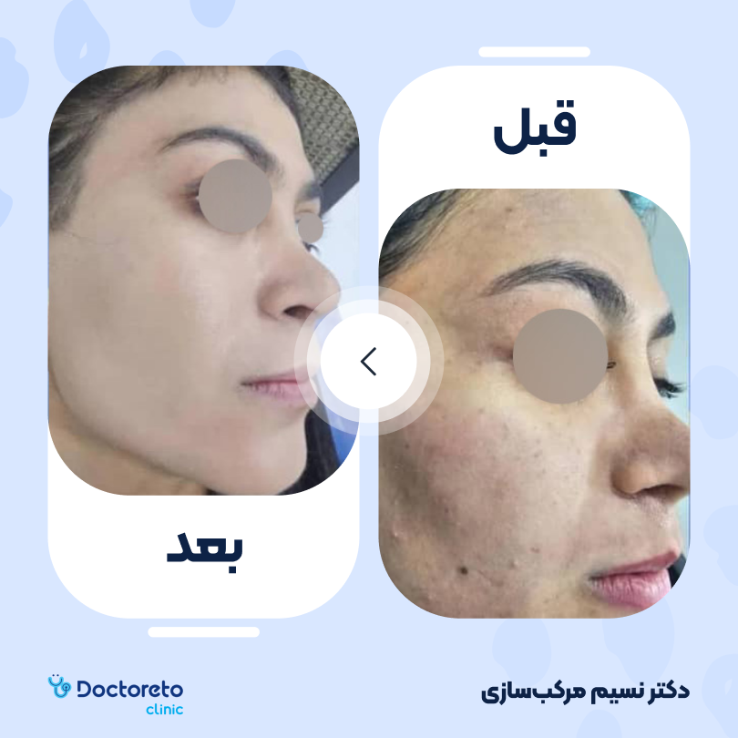 جوانسازی صورت با لیزر rf فرکشنال (یک جلسه) دکتر نسیم مرکب سازی در تهران 3