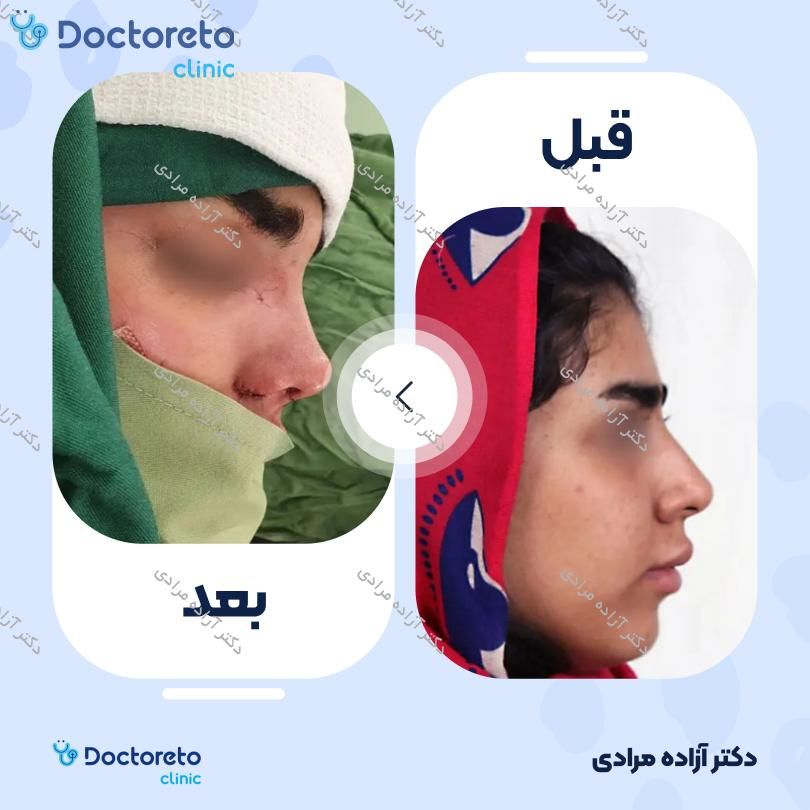 عمل جراحی بینی (رینوپلاستی) دکتر آزاده مرادی در شیراز 2