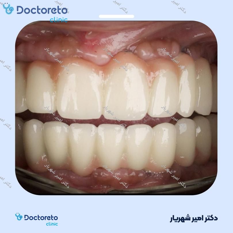 ایمپلنت اشترومن (iti) سوئیسی بدون روکش (هر واحد) دکتر امیر شهریار در تهران 3