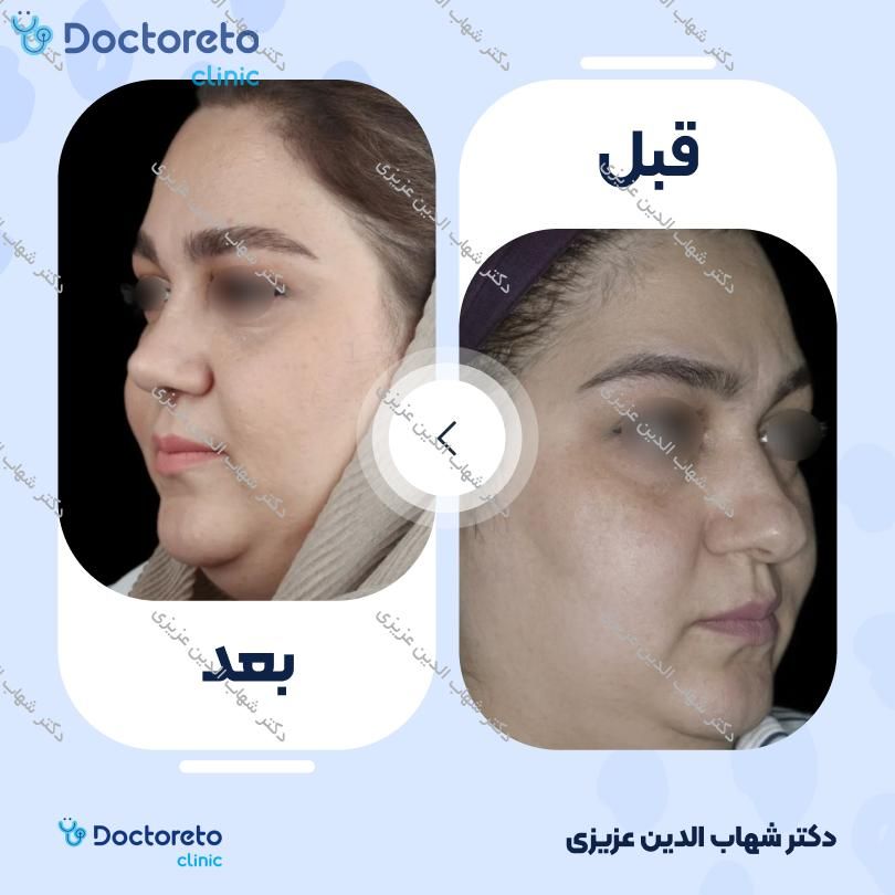 جراحی انحراف بینی (سپتوپلاستی) دکتر شهاب الدین عزیزی در تهران 9