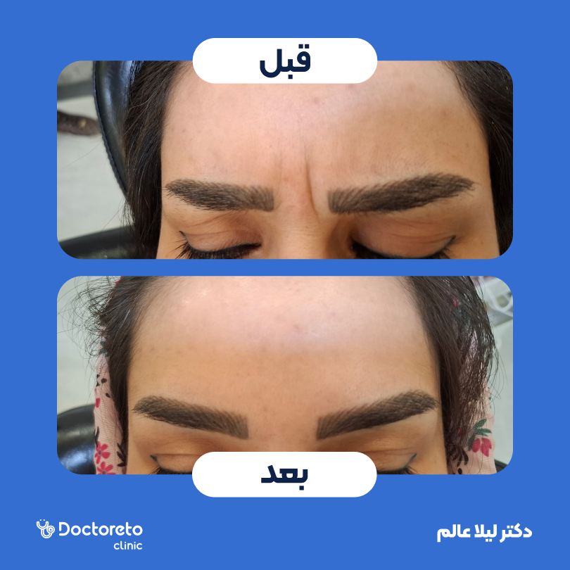 تزریق بوتاکس صورت (پیشانی، خط اخم، پنجه کلاغی) با برند دیستون