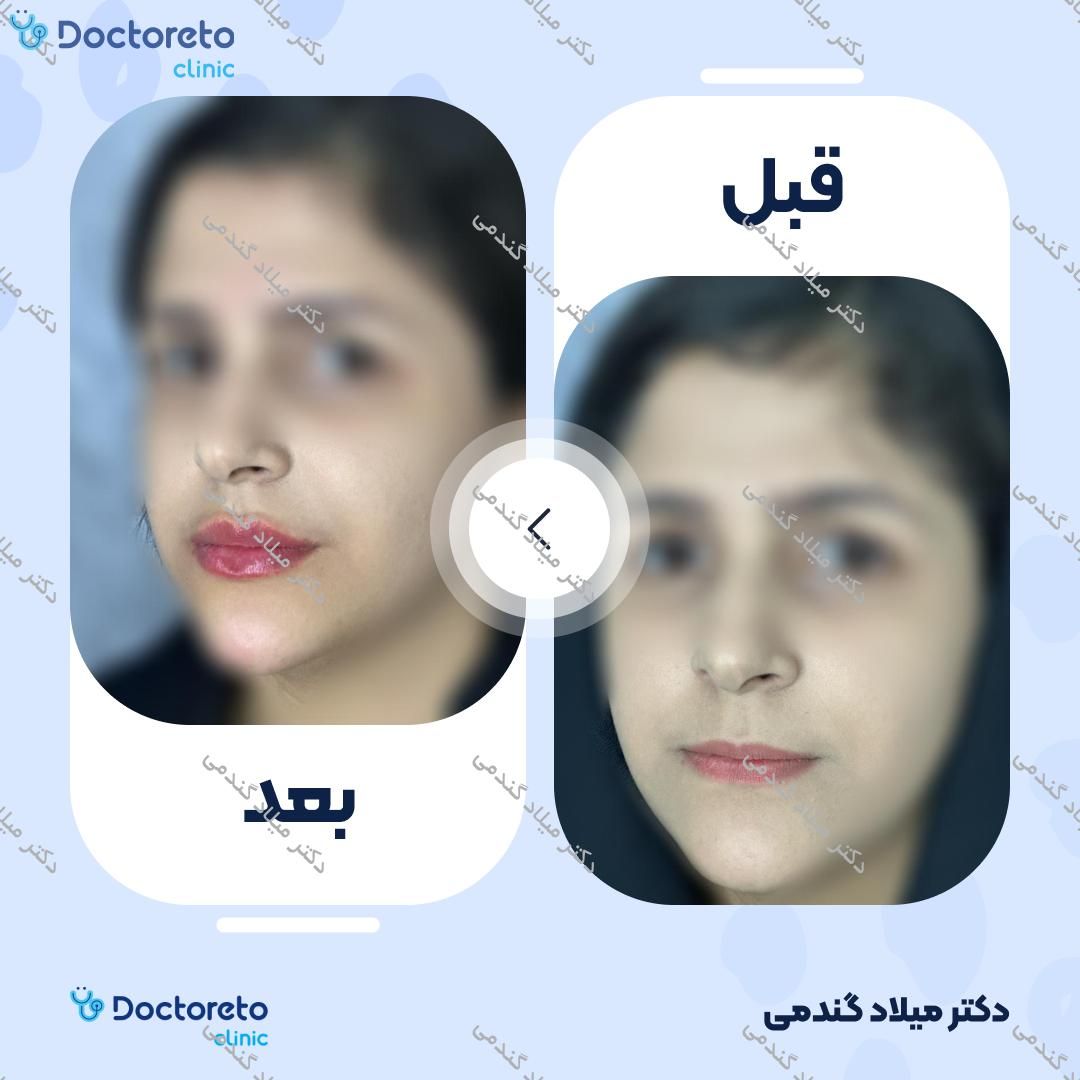 تزریق ژل لب با برند نئوویا (1CC)