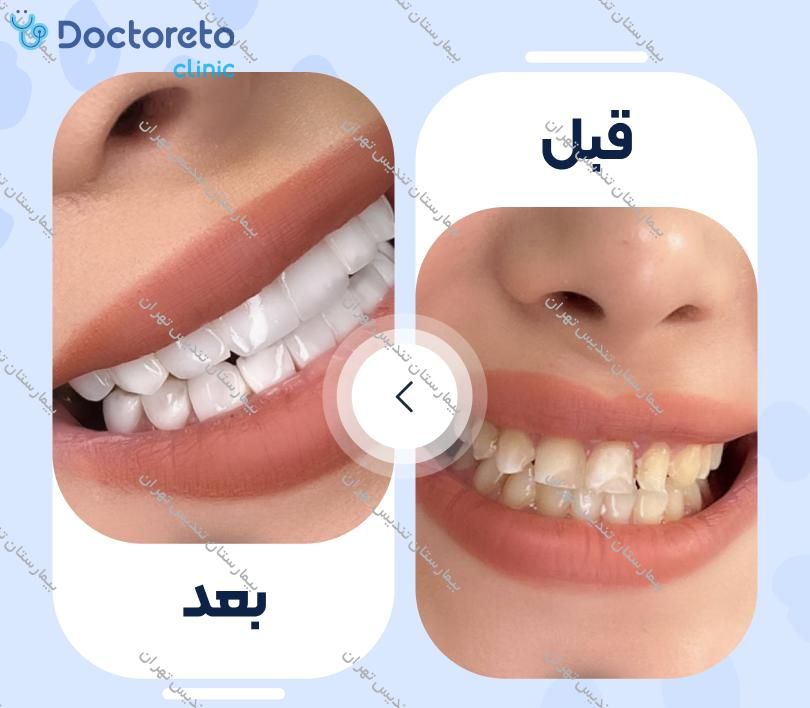 جرمگیری بالای لثه