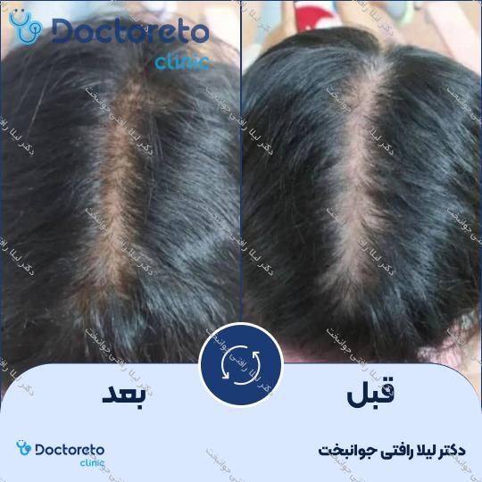 پلاسماتراپی موی سر جهت جلوگیری از ریزش دکتر لیلا رافتی جوانبخت در مشهد 2