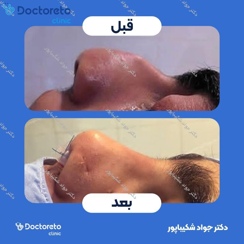 عمل زیبایی بینی (رینوپلاستی) دکتر جواد شکیباپور در شیراز 2